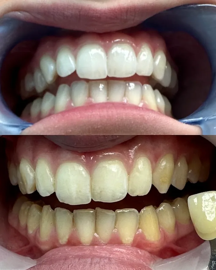 Dott.ssa Colella Camilla, Igienista Dentale. Sbiancamento denti. Fitoterapia. Ozonoterapia.