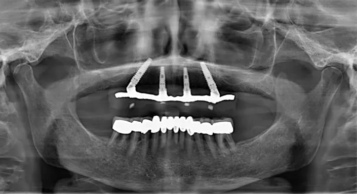 Dr.Giuseppe Brindisi – Medico Odontoiatra – Chirurgia orale e Implantologia – Ortodonzia